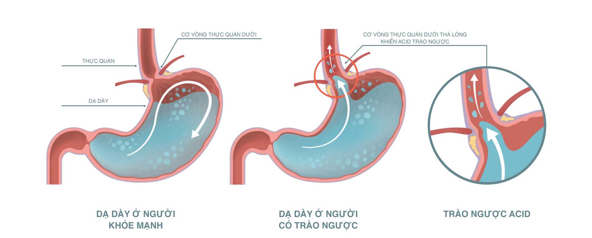 Trào ngược axit dạ dày